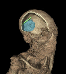The CT scan of the skull of the mummy of an adult man (name unknown). The scan shows the remains of the brain (coloured in blue) and evidence of a tool that was left in the skull as a mistake during the mummification process (in green).